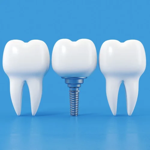 Dentures, Crowns & Bridges, Implants
